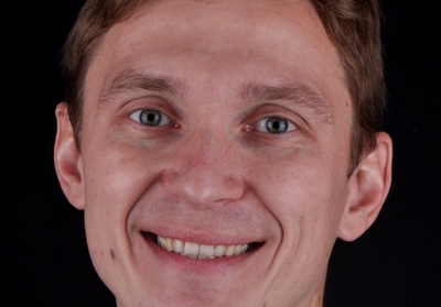 Tratamento de peri-implantite - a propósito de um caso clinico