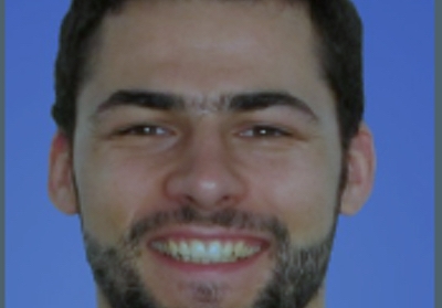 Frenectomia lingual : a propósito de um caso clínico