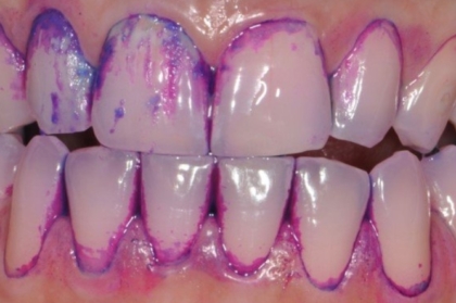 Hands-on de Guided Biofilm Therapy (manhã)