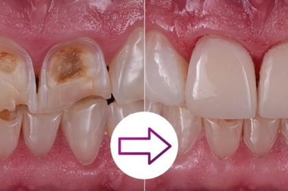 Hands-on "O desafio de restaurar dentes escurecidos com resinas compostas diretas" (tarde)