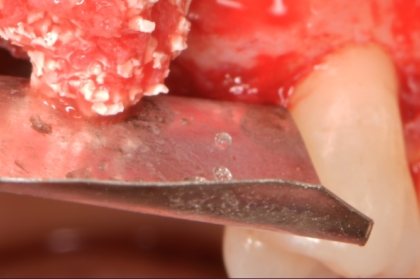 Hands-on "Nova técnica para uma ROG mais segura com o uso do NOVAMag®" (manhã)