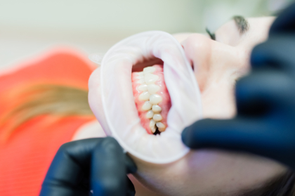 Hands-on prótese removível "Detalhes que marcam o sucesso em prótese parcial removível"