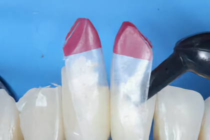 Hands-on "Método Bioclear: resultados expectáveis com técnicas para eliminar espaços ou triângulos negros" (manhã)