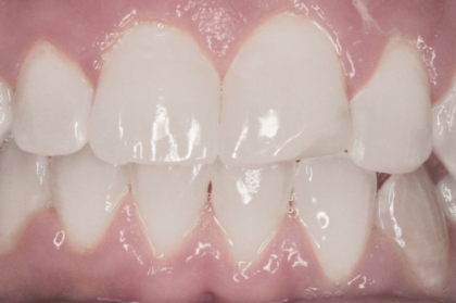 Hands-on "Alinhadores Clearcorrect: Os pontos chave de um caso ortodôntico - desde a submissão até ao tratamento" (manhã)