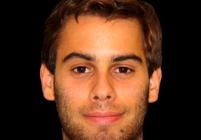 Regeneração óssea guiada com membrana não reabsorvível na zona estética – Caso clínico