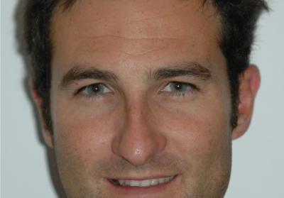 Hipomineralização dentária e reabilitação em zona estética Caso Clínico